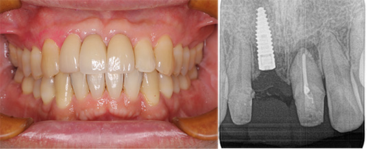 インプラントケース１