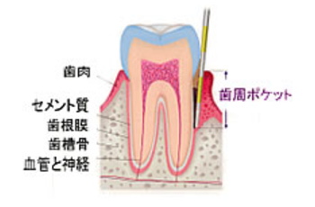 歯周ポケット検査