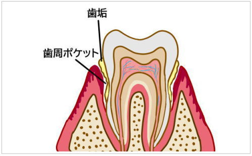 歯周ポケット